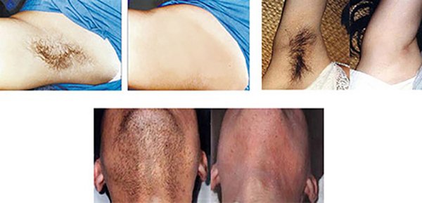 800W Diode Laser Hair Removal treatment effect