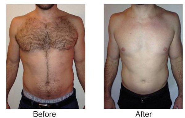 Diode Laser Hair Removal Treatment effect