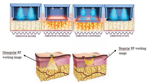 Monopolar RF treatment process