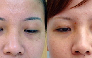 laser nd yag eyebrow Tattoo removal 1