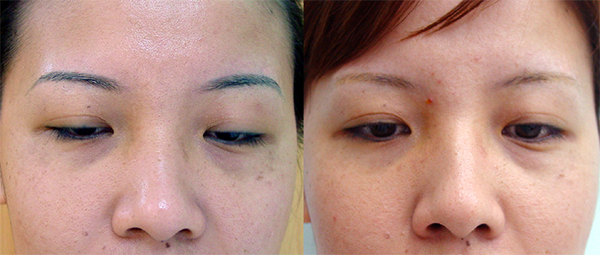 QSwitched ND YAG Laser  Berman Skin Institute