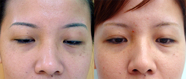 laser nd yag eyebrow Tattoo removal 1