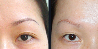 laser nd yag eyebrow Tattoo removal 2