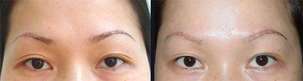 laser nd yag eyebrow Tattoo removal 2