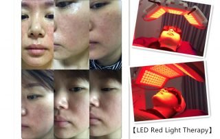 PDT LED Photodynamic Therapy