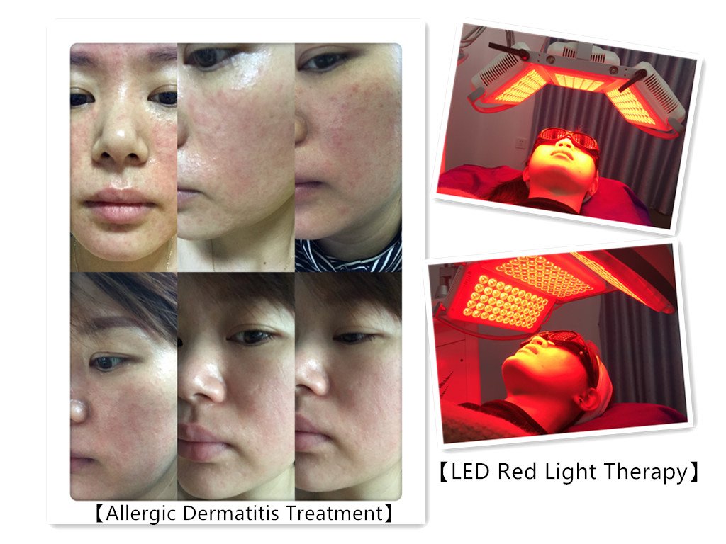 PDT LED Photodynamic Therapy