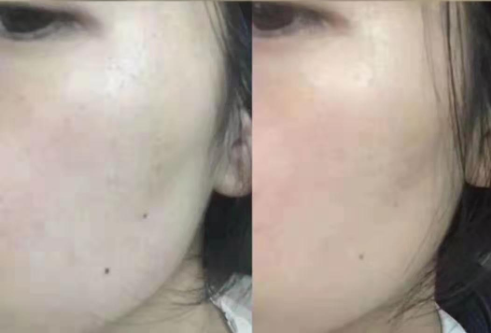 Pico laser treatment huafeimedical.png1