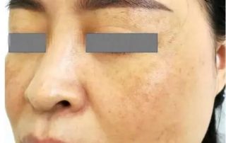 melasma