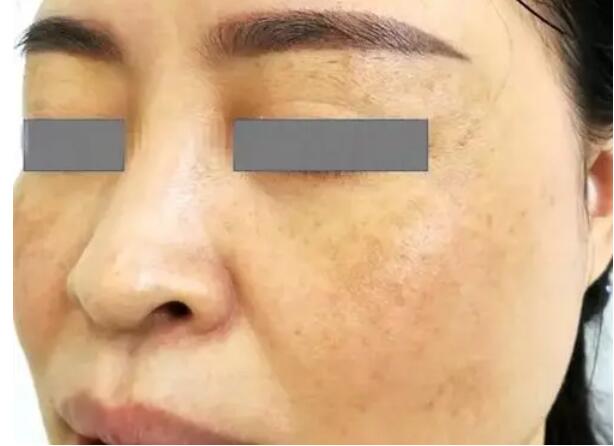 melasma