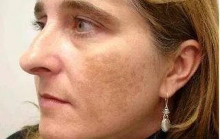 melasma1