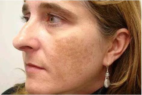 melasma1