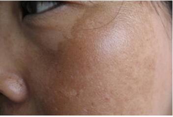 melasma5