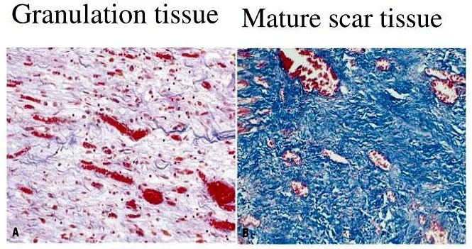 Granulation tissue