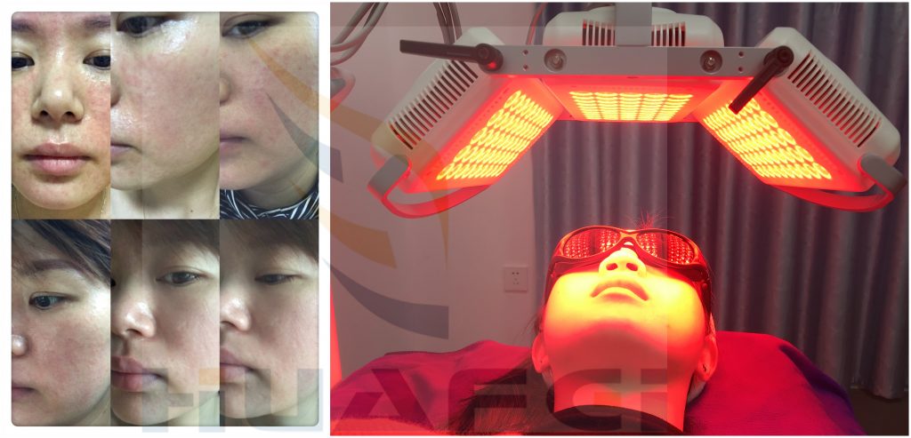 PDT LED Photodynamic Therapy huafeimedical 副本