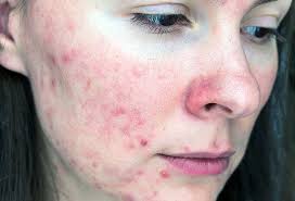 rosacea