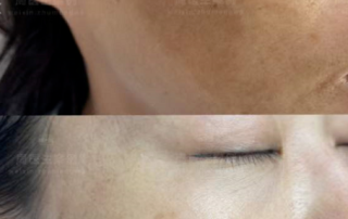 Treating Melasma with the 1927nm Thulium Laser